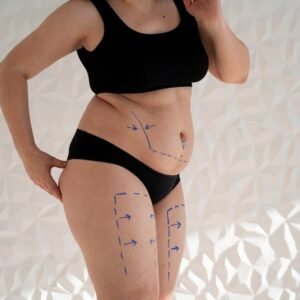 Lipoedema - Vital Global Care