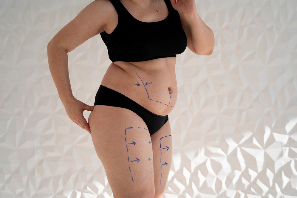 Lipoedema - Vital Global Care