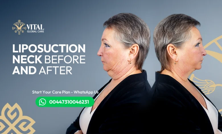 Liposuction Neck Before and After Say Goodbye to Double Chin