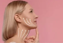 Where Are the Incisions Made for a Facelift - 2026 Techniques